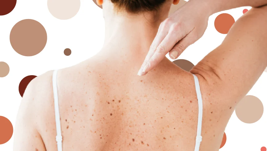 ¿Qué es el melanoma?